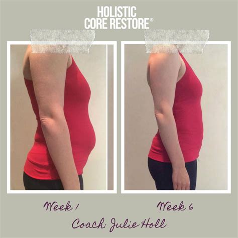 It's worth it! Get a consult with an ASPS board certified plastic surgeon. . Diastasis recti surgery before and after photos